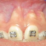 braces tooth extraction